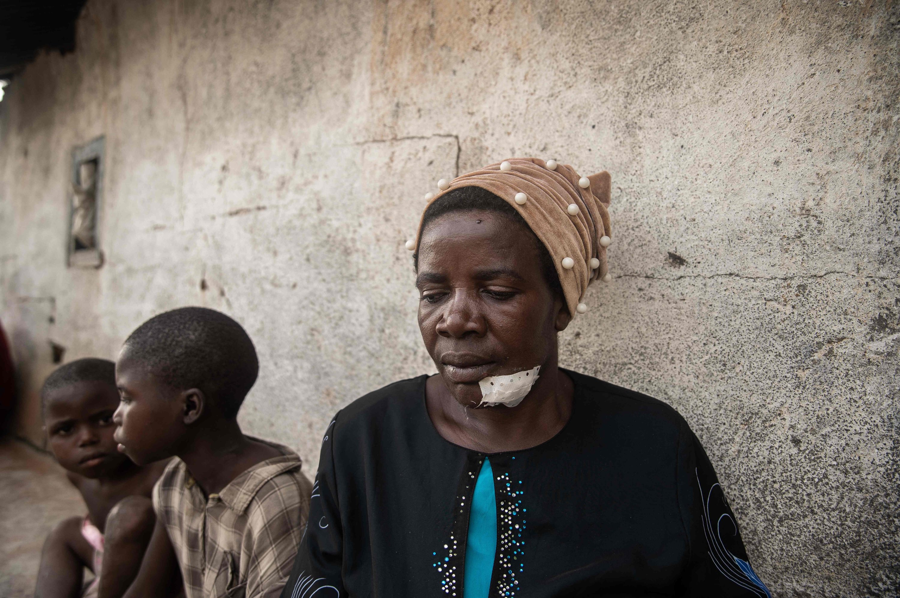 373061 Kimoka (R), a woman who was shot in the cheek while attempting to clean her plot and burn the trash, poses for a photo with her family, Sake, DRC, Feb. 27, 2025. (AFP Photo)