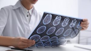 A new technique involving ultra-powerful MRI scanners could help doctors identify tiny differences in the brains of people with treatment-resistant epilepsy that may have otherwise been missed, a trial has found. (Shutterstock Photo)