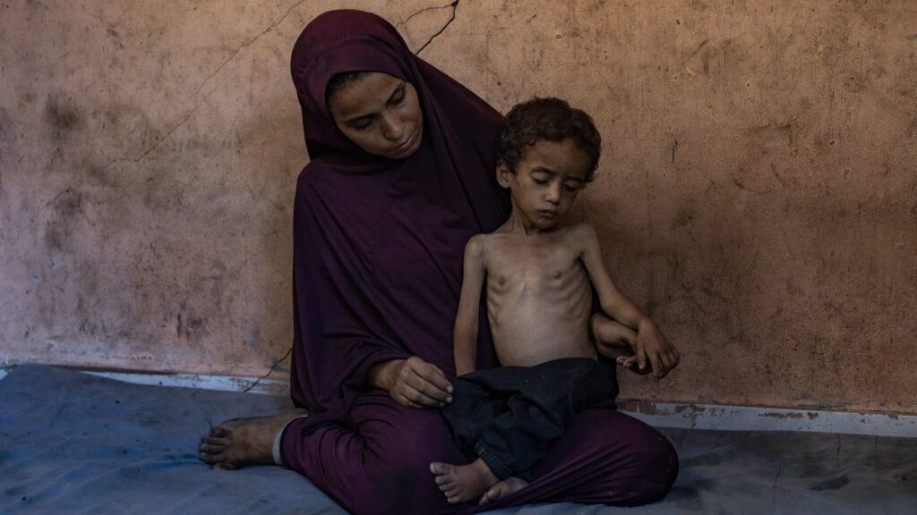 Palestinian child Yazan Abu Foul, aged 2, is cared for by his mother Naima, as he suffers from severe malnutrition due to the acute shortage of food caused by the Israeli blockade on the Gaza Strip, in al-Shati refugee camp, west of Gaza City, July 19, 2025. (EPA Photo)