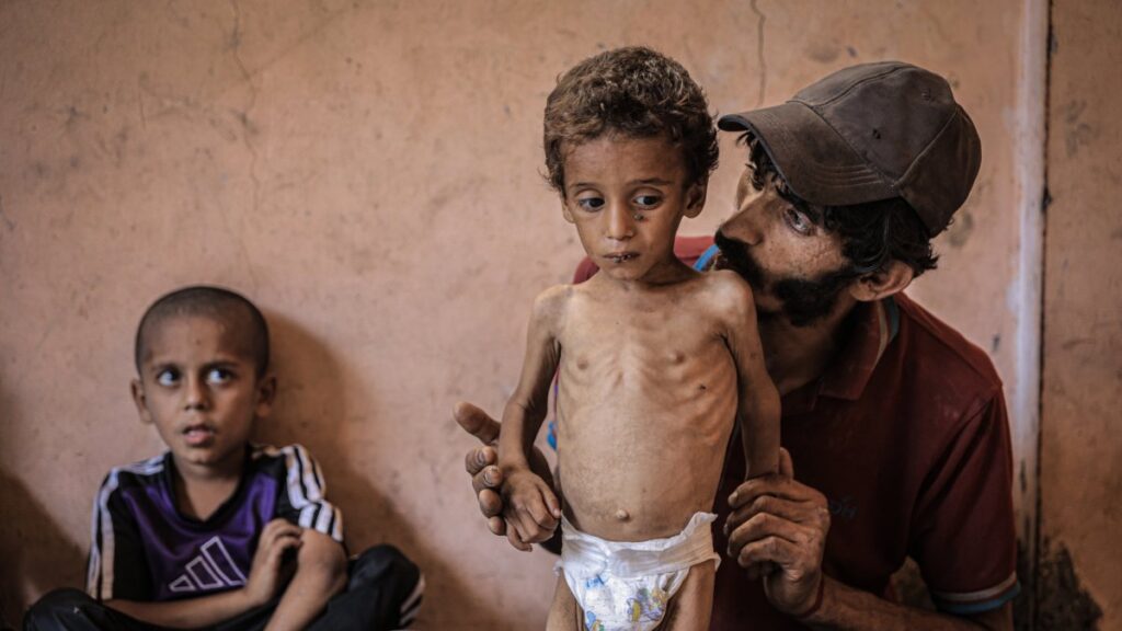 A Palestinian father cradles his sick 2-year-old son Abu Ful, who is also displaying signs of malnutrition, inside their tent at the Al-Shati refugee camp, west of Gaza City, on July 13, 2025. (AA Photo)