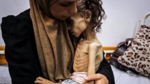 Nine-year-old Maryam Duvvas, who is being treated at a hospital, is in critical condition due to severe malnutrition, Gaza, Palestine, Aug. 4, 2025. (AA Photo)